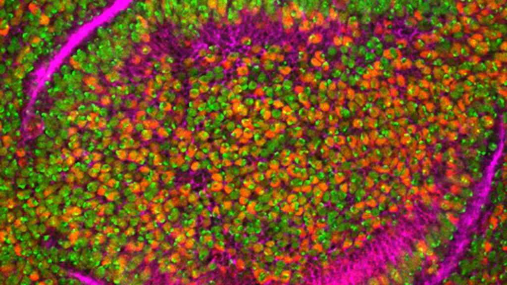Lipids in blood predict nerve damage risk among patients with type 2 diabetes