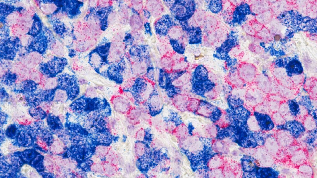 Cancer cells exposed to high viscosity move better and their metastatic potential increases